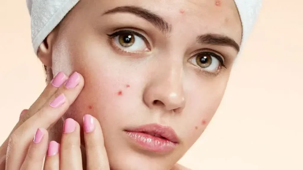 Acne Treatment in Chevy Chase, MD