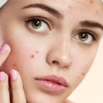 Acne Treatment in Chevy Chase, MD